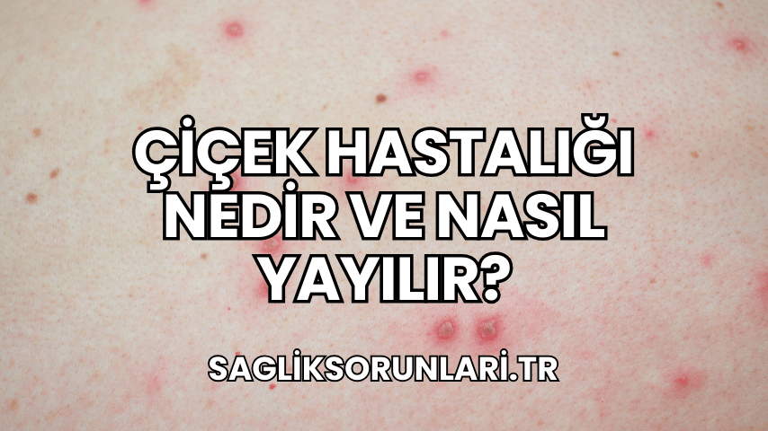 Çiçek Hastalığı Nedir ve Nasıl Yayılır?