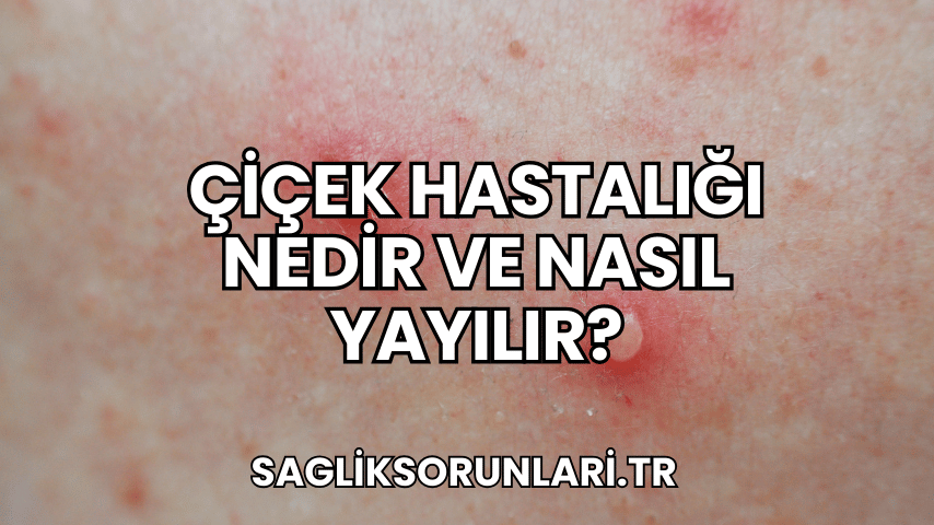 Çiçek Hastalığı Nedir ve Nasıl Yayılır?