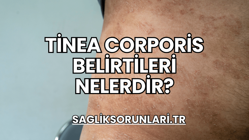 Tinea Corporis Belirtileri Nelerdir?