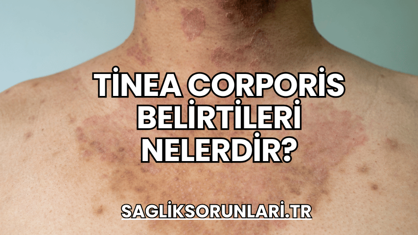 Tinea Corporis Belirtileri Nelerdir?