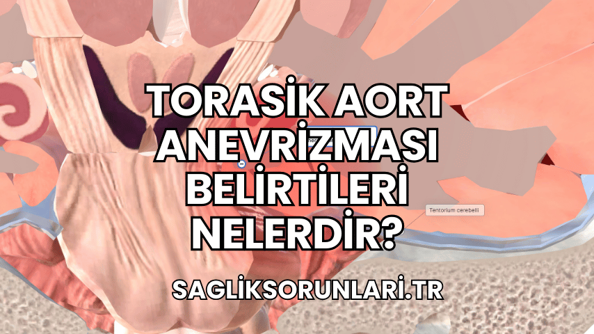 Torasik Aort Anevrizması Belirtileri Nelerdir?