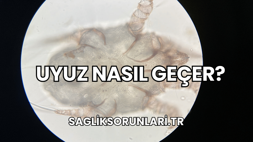 Uyuz Nasıl Geçer?