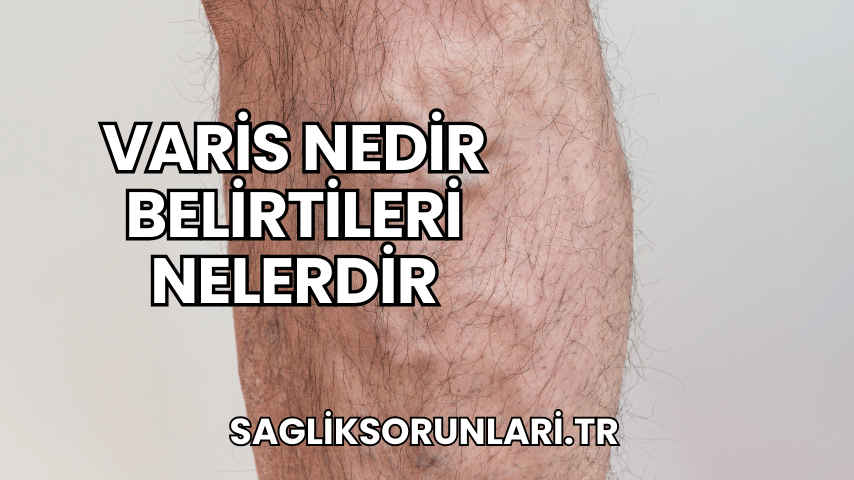 Varis Nedir Belirtileri Nelerdir