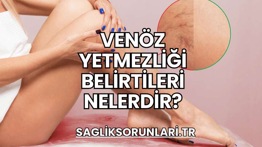 Venöz Yetmezliği Belirtileri Nelerdir?