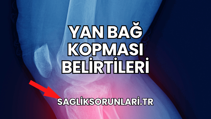 Yan Bağ Kopması Belirtileri