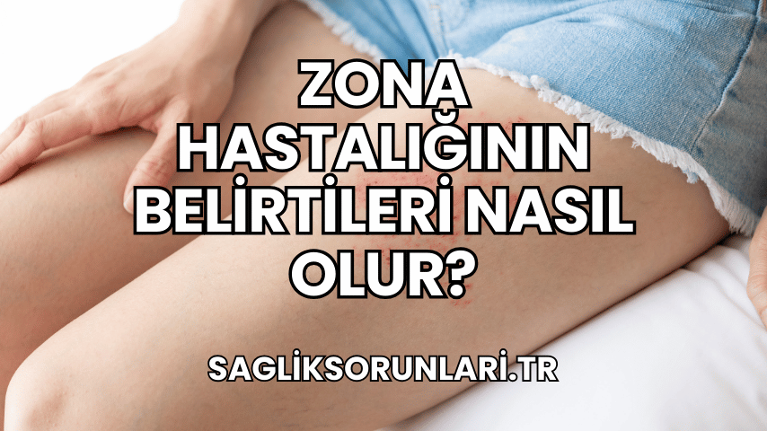 Zona Hastalığının Belirtileri Nasıl Olur?