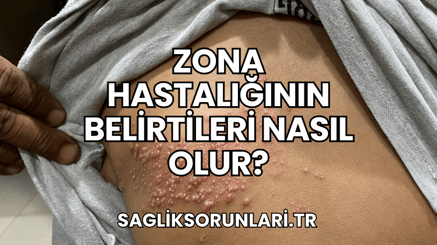 Zona Hastalığının Belirtileri Nasıl Olur?