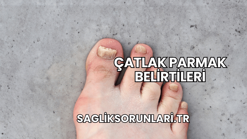 Çatlak Parmak Belirtileri