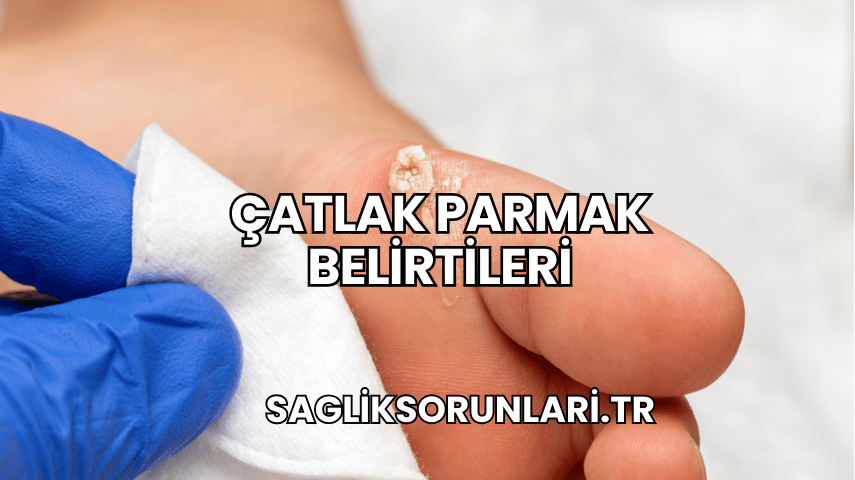 Çatlak Parmak Belirtileri