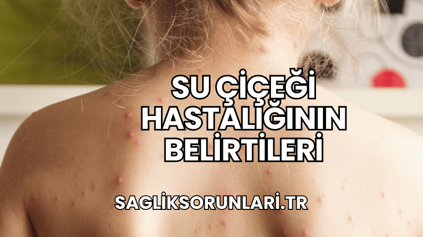 Su Çiçeği Hastalığının Belirtileri